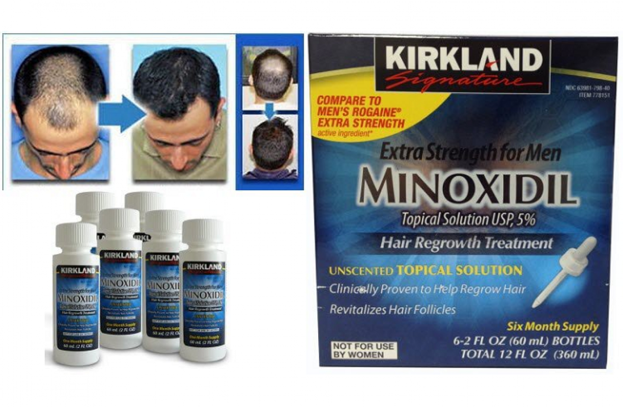 Thuốc Mọc Tóc Minoxidil 5 Kirkland Có Tốt Không Giá Bao Nhiêu
