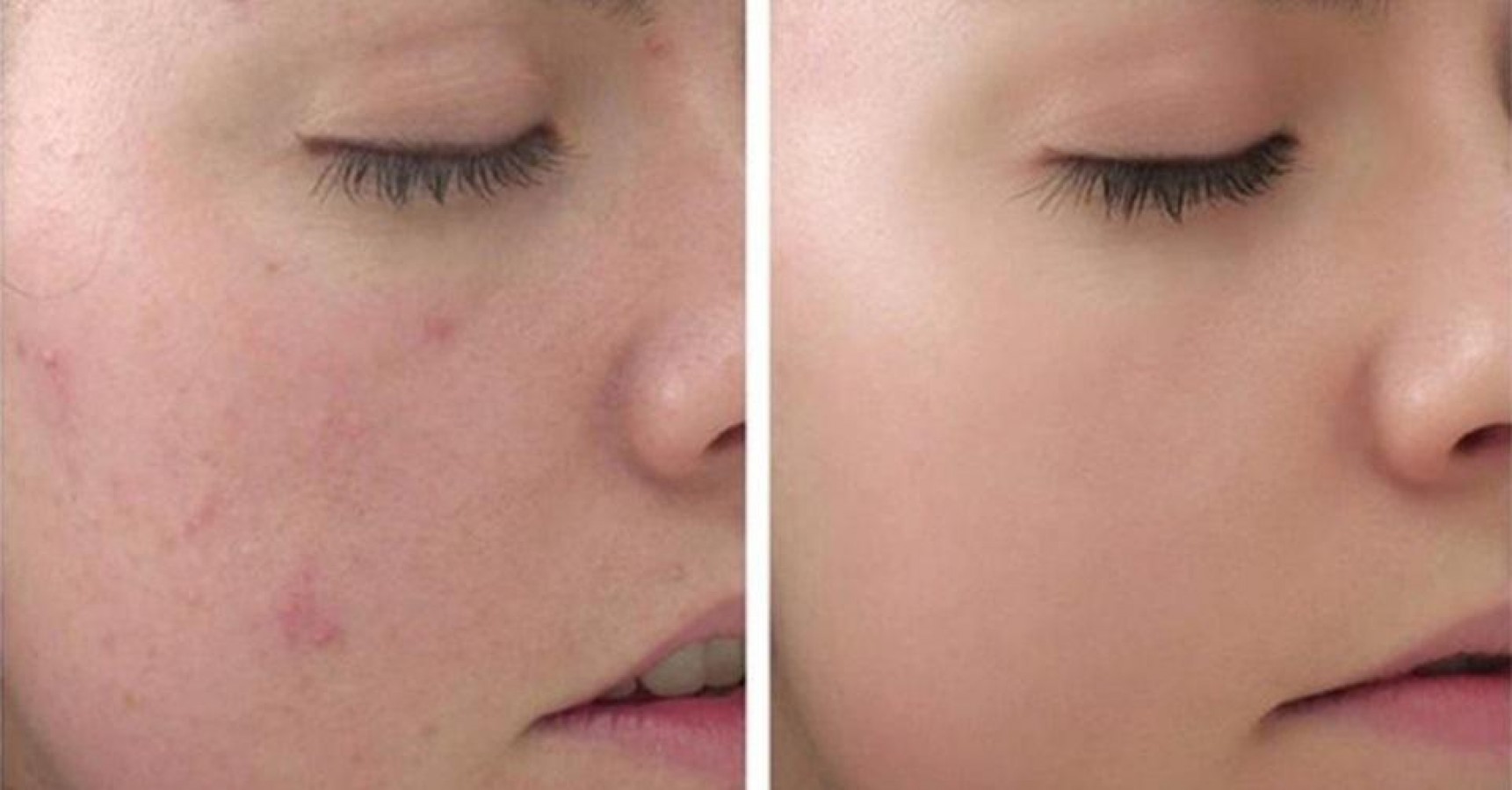 Gel Cải Thiện Mụn Clean & Clear Advantage Acne Spot Treatment