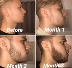 Kirkland Minoxidil Topical Aerosol 5 Foam Hair Regrowth Treatment For Men   Bọt Kích Mọc Tóc