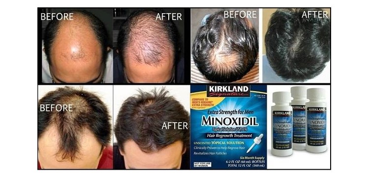 thuốc Minoxidil 5, thuốc Minoxidil 5 có hiệu quả không, thuốc Minoxidil 5 bailleul, thuoc Minoxidil 5 ban o dau, thuoc xit Minoxidil 5, thuốc mọc râu Minoxidil 5, thuốc mọc râu Minoxidil 5 có tốt không, thuốc mọc tóc Minoxidil 5, thuốc mọc râu Minoxidil 5 của mỹ, thuốc mọc râu Minoxidil 5 hà nội